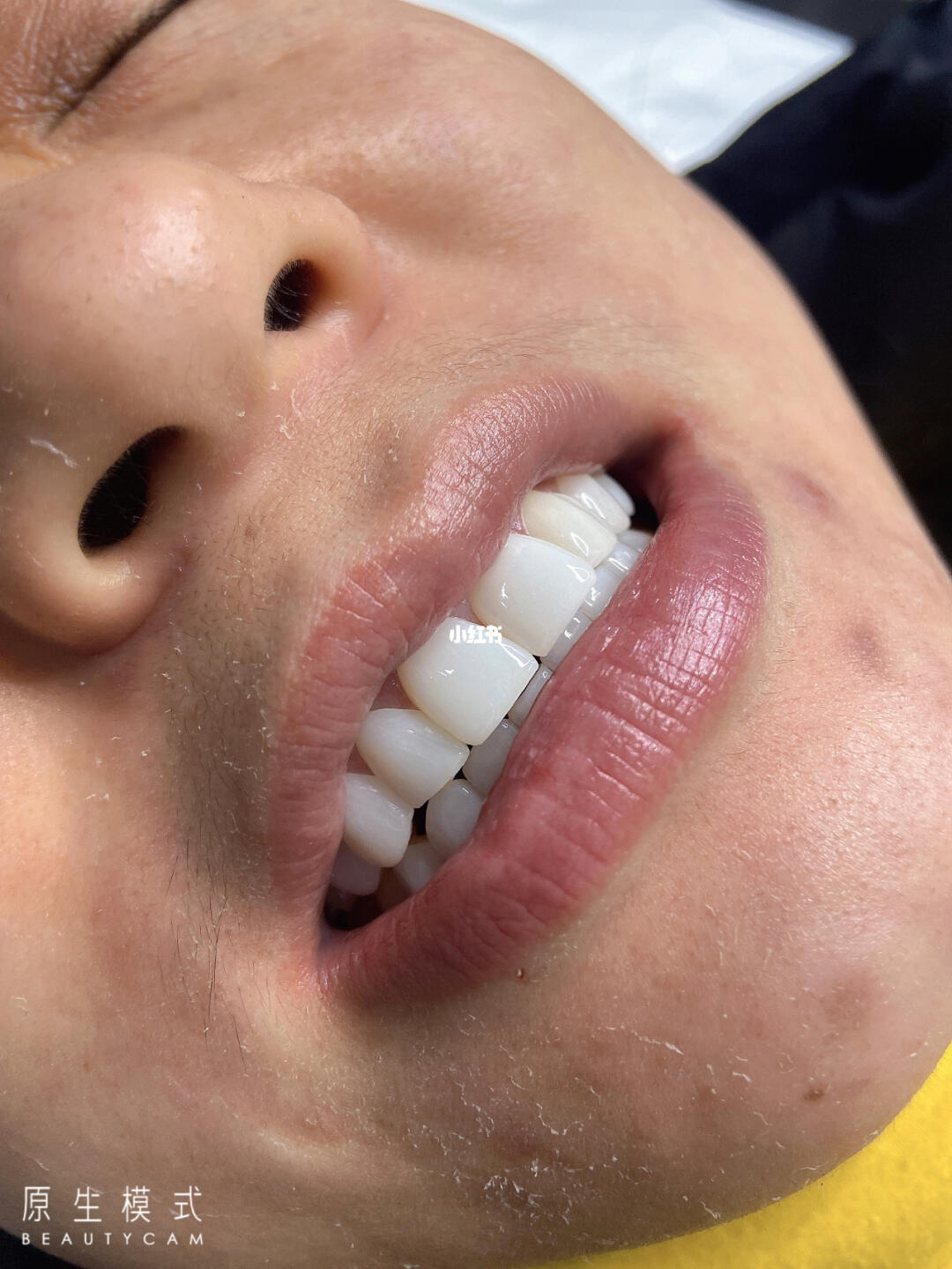 四環(huán)素牙貼面價格解析與比較指南